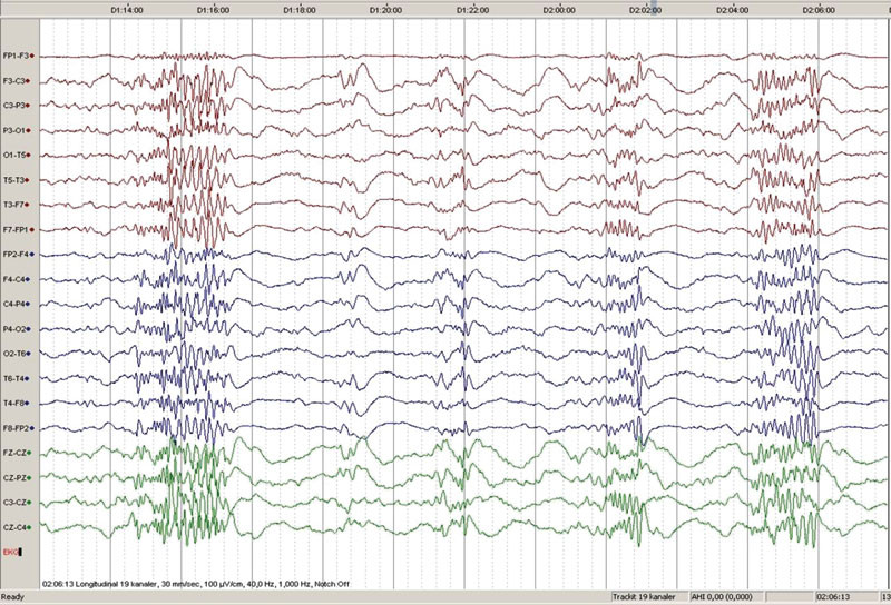 Figur 2  EEG tatt under s&oslash;vn hos en pasient med Lennox-Gastauts syndrom viser utbrudd av rask paroksysmal EEG-aktivitet &hellip;