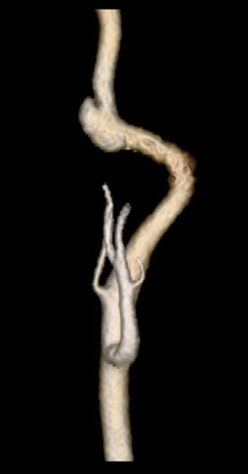 Figur 1  CT-angiografi (tredimensjonal rekonstruksjon) viser funn forenlig med pseudoaneurisme p&aring; h&oslash;yre a. carotis interna&hellip;