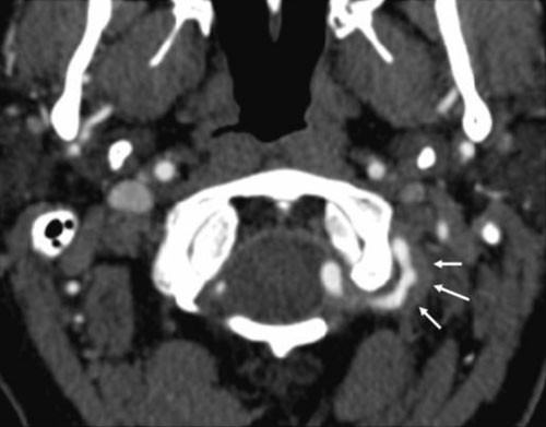 Figur 2  Aksial CT-angiografi viser uregelmessig kontrastf&oslash;rende lumen og patologisk veggfortykkelse av venstre&hellip;