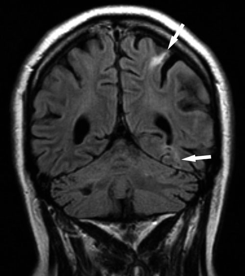 Figur 3  MR med FLAIR-sekvens (fluid attenuated inversion recovery) viser flere nye sm&aring; iskemiske lesjoner (piler) i venstre&hellip;