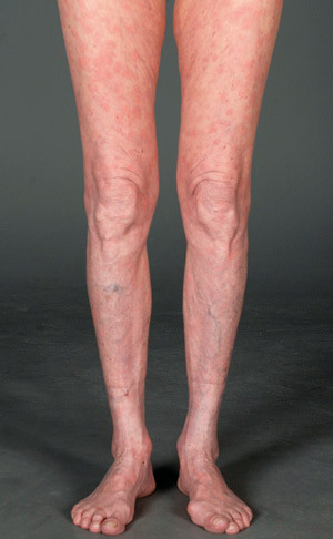 Figur 1  Urtikarielt utslett