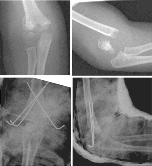 Figur 3  Pre- og postoperativ front- og sideprojeksjon av en dislokert Gartland 3 suprakondyl&aelig;r humerusfraktur hos en fem &aring;r&hellip;