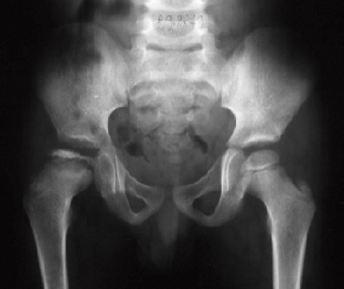 Figur 1  R&oslash;ntgenbilde av &aring;tte &aring;r gammel gutt med Calv&eacute;-Legg-Perthes&rsquo; sykdom i h&oslash;yre hofte i fragmenteringsfasen. Hele&hellip;