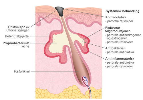 Figur 1  Talgkjertelens anatomi og angrepspunkter for ulike systemiske legemidler