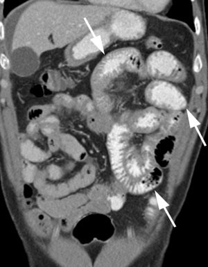 Figur 1  CT abdomen i koronal rekonstruksjon viser patologiske jejunumslynger med fortykket vegg og uregelmessige&hellip;