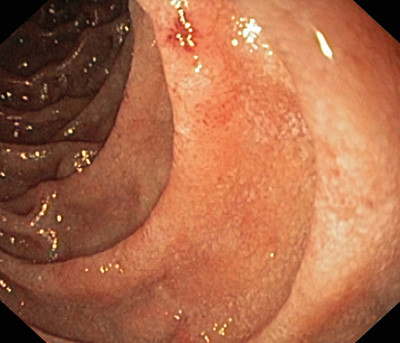 Figur 2  Endoskopibilde fra &oslash;vre del av tynntarm (jejunum) hvor slimhinnene fremtrer som lett betente