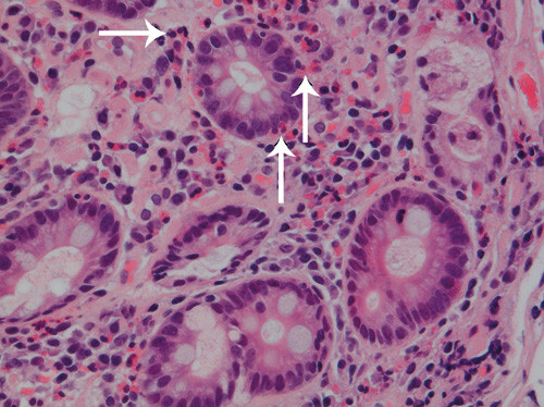 Figur 3  Histologisk snitt fra slimhinne i proksimale tynntarm viser &oslash;kt antall eosinofile granulocytter (piler) i lamina&hellip;