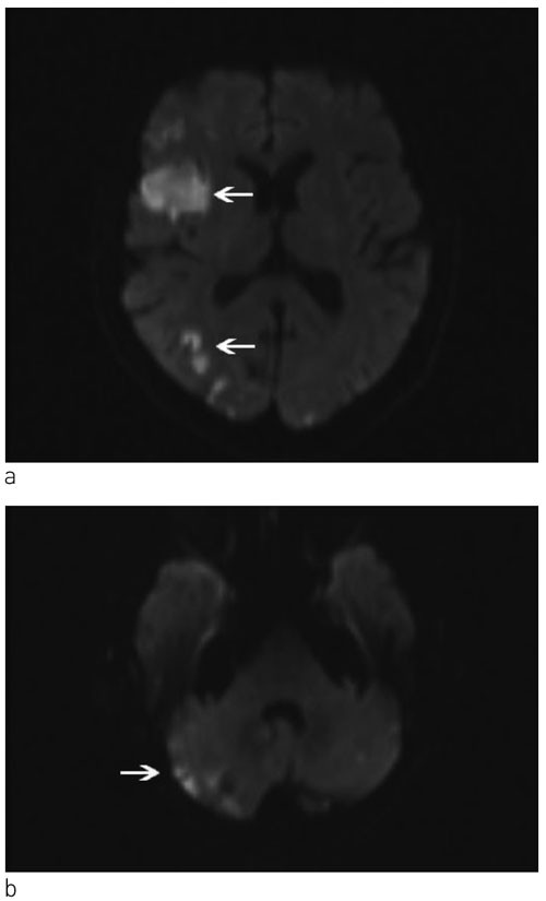 Figur 1  Diffusjonsvektet MR av hjernen ved f&oslash;rste innleggelse viser infarkter (pil) a) over og b) under tentoriet