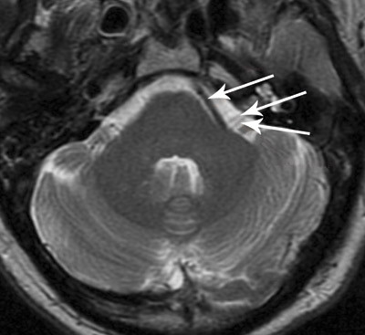 Den &oslash;verste pilen viser arterie, den midterste n. facialis og den nederste n. vestibulocochlearis