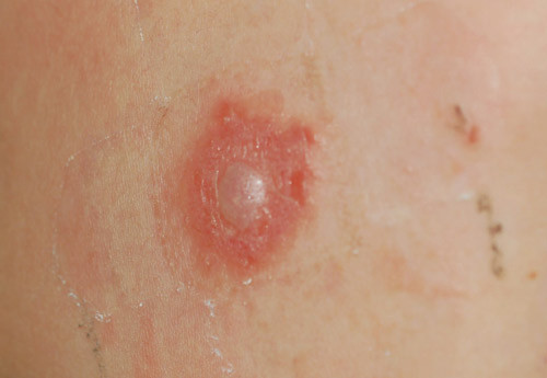 Figur 2  Positiv testreaksjon p&aring; parafenyldiamin