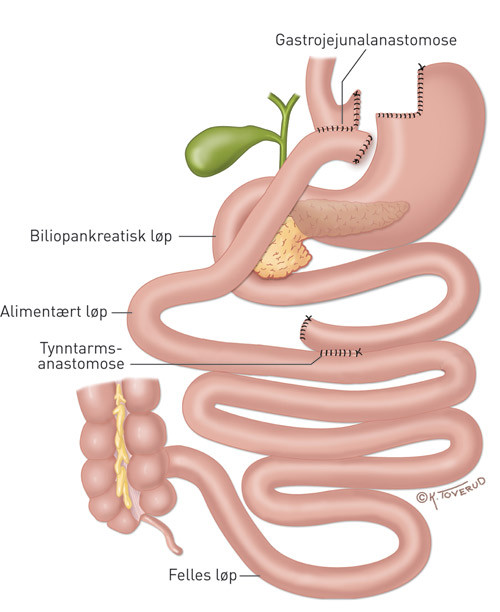 Figur 2  Gastrisk bypass. Magesekken deles proksimalt, tynntarmen deles ca. 50 cm distalt for Treitz&rsquo; ligament og det&hellip;