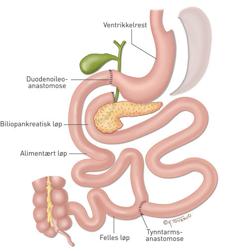 Figur 4  Duodenal omkobling. Magesekkens volum reduseres ved vertikal gastrektomi. Det aliment&aelig;re l&oslash;pet dannes ved at&hellip;