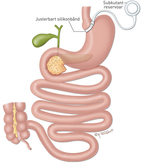 Figur 5  Justerbart b&aring;nd. Justerbart silikonb&aring;nd med forbindelse til et subkutant reservoar plasseres rundt proksimale del&hellip;