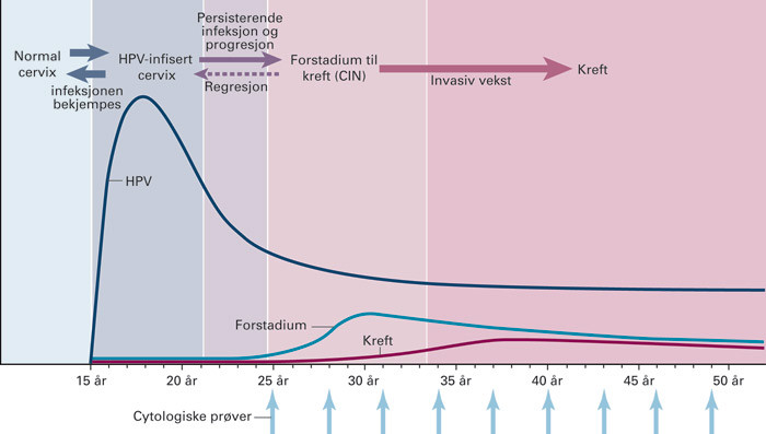 Figur 1  Naturlig forl&oslash;p av HPV-infeksjon og utvikling av forstadier til livmorhalskreft. Kvinner i ten&aring;rene og i tjue&aring;rene&hellip;
