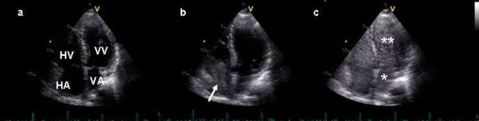Figur 3  Transtorakal ekkokardiografi. Apikal firekammer registrering. a) F&oslash;r infusjon av saltvannskontrast. HA = h&oslash;yre&hellip;