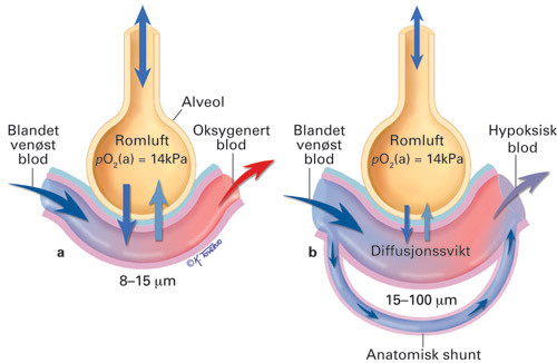 Figur 4  Mekanismer ved utvikling av hypoksemi hos pasient med hepatopulmonalt syndrom. Hos en frisk person (a) som har jevn&hellip;