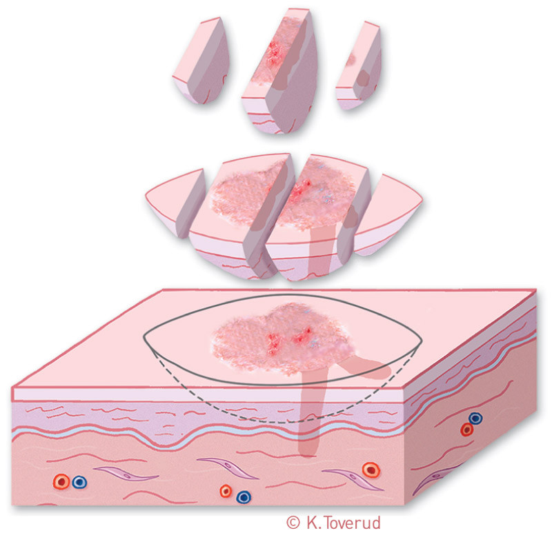 Figur 2  Vanlig b&aring;teksisjon som viser ikke-radikalt fjernet tumor, som ikke kommer frem i vertikale uttatte snitt