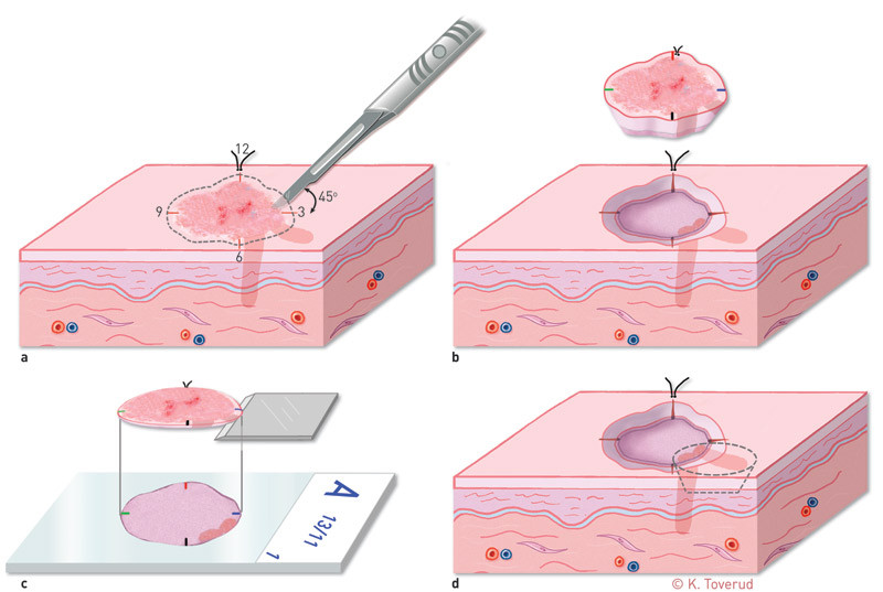 Figur 3  a) Merket resektat med synlig tumor eksideres med 45&deg; vinkel og flat bunn. b) Uttatt resektat fargekodes. c)&hellip;