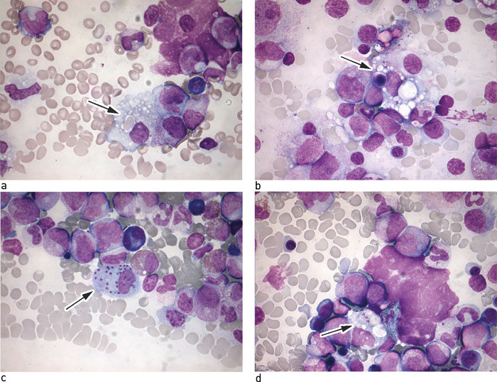 Figur 1  a) Beinmargsutstryk med makrofag med inklusjoner av erytrocytter (pil). b) Beinmargsutstryk med makrofag med&hellip;
