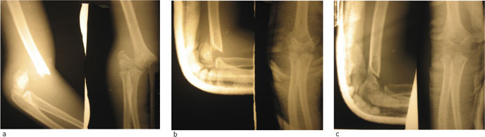 Figur 1  R&oslash;ntgenbilder av albuen til en av v&aring;re pasienter. a) fra innleggelsen, b) stillingen etter f&oslash;rste reposisjonsfors&oslash;k&hellip;