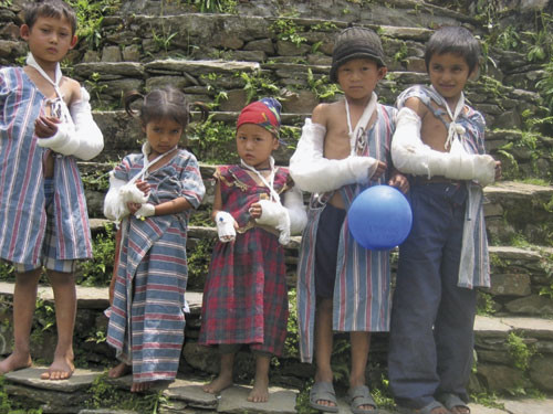 Figur 2  Suprakondyl&aelig;r humerusfraktur er en arbeidsskade hos barn i Nepal. Den viser stor sesongvariasjon. Her er fem barn&hellip;