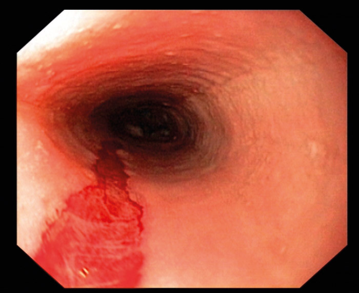 Figur 3  Rift i spiser&oslash;ret etter passasje med 9,8 mm skop. Samme pasient som p&aring; figur 1