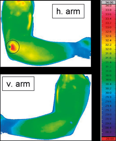 Figur 2  Infrar&oslash;dt termogram hos en pasient der det var klinisk mistanke om lateral epikondylitt i h&oslash;yre albue. Pasienten&hellip;