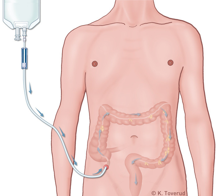 Figur 2  Malones blindtarmstomi for antegrad irrigasjon. Omarbeidet med tillatelse fra Elsevier (8, 30)