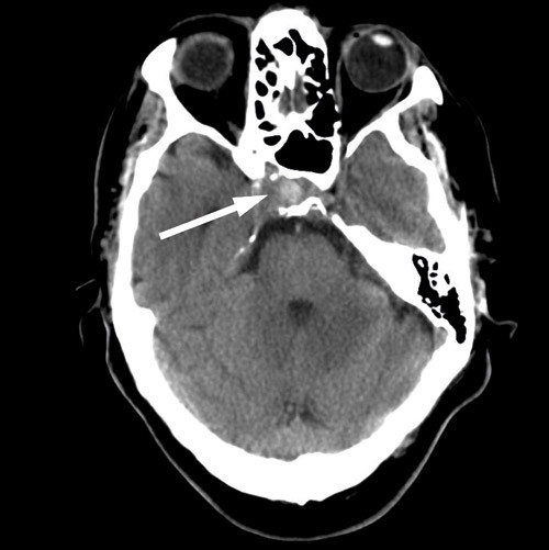 Figur 1  CT ved innkomst av pasienten. Man ser en st&oslash;rre eroderende prosess (pil) i h&oslash;yre del av sfenoidalsinus, med&hellip;