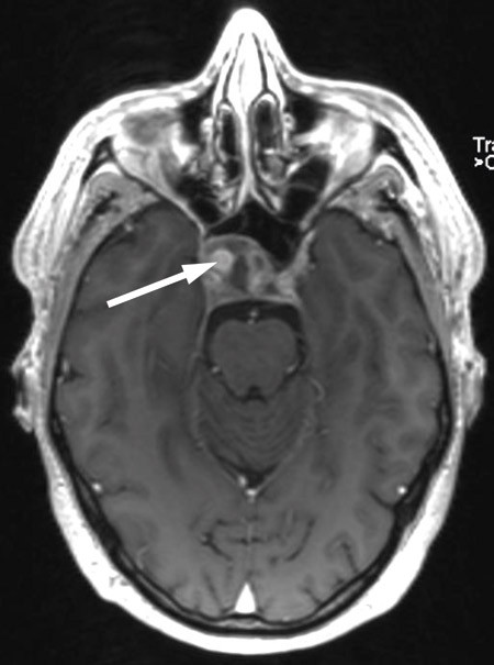 Figur 3  MR tatt like etter innkomst. Sfenoidal sinusitt, osteomyelitt i clivus og aneurisme midt i lesjonen (pil)&hellip;