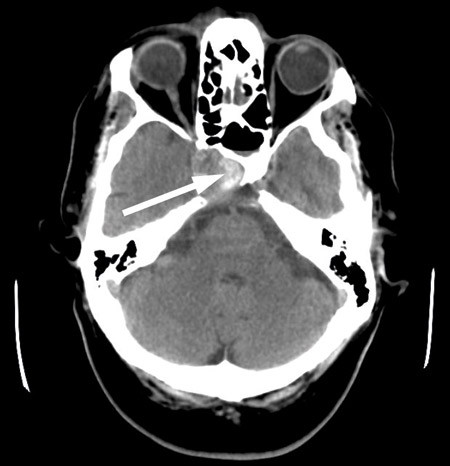 Figur 4  CT tatt like etter hyperakutt forverring av hodepineplagene. Den patologiske prosessen i sfenoidalsinus og clivus &hellip;