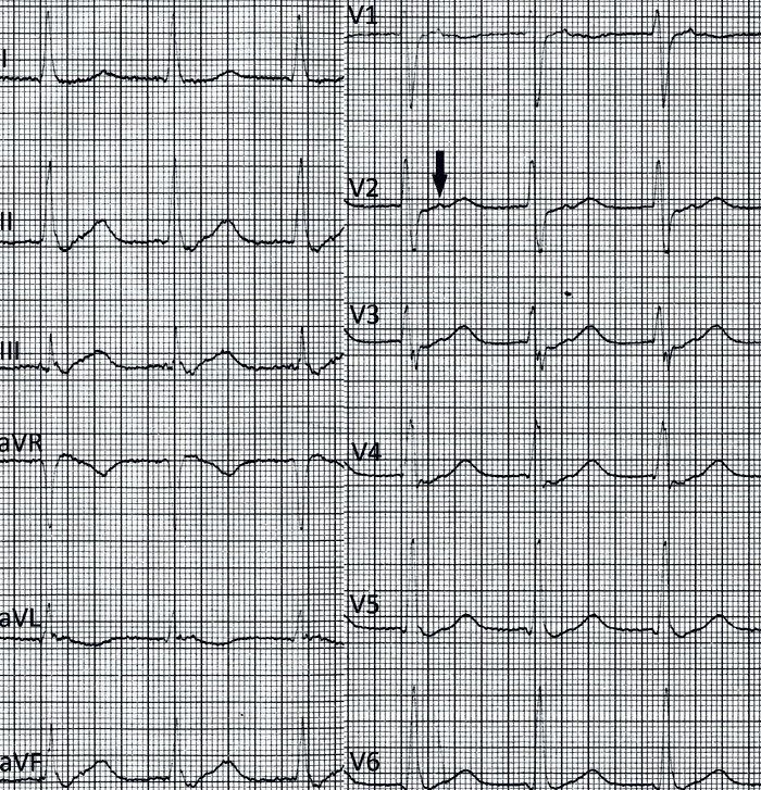 Figur 1  EKG tatt ca. et &aring;r f&oslash;r aktuelle innleggelse. Supraventrikul&aelig;r takykardi med frekvens 127/min og med P-b&oslash;lger ca&hellip;