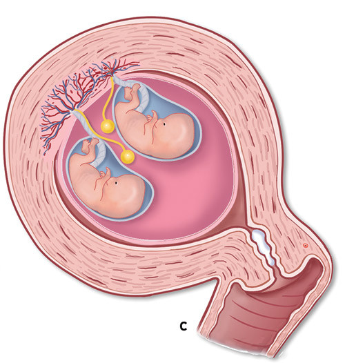 Figur 1  c) En felles placenta/en fostersekk