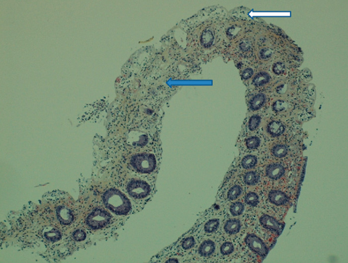 Figur 2  Histologisk bilde av iskemisk kolitt (hematoksylin-azofloxin-safran-farging). Tykktarmslimhinnen med l&oslash;snet&hellip;
