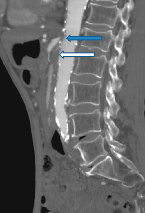 Figur 3  CT-angiografibilde som viser 8 mm lang okklusjon av truncus celiacus (bl&aring; pil) og 2,5 cm lang okklusjon av arteria&hellip;
