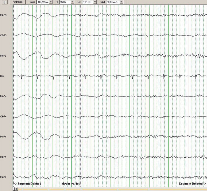 Figur 1  Utklipp av EEG tatt mens pasienten l&aring; i intensivavdeling, omtrent fire uker etter innleggelse i&hellip;
