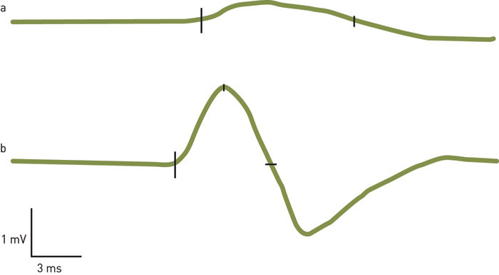 Figur 2  To forskjellige motoriske svarpotensialer registrert fra v&aring;r pasient over m. extensor digitorum brevis ved&hellip;