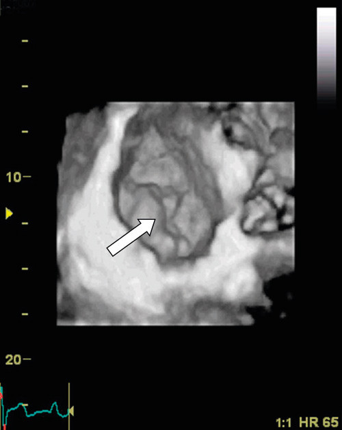 Figur 2  Transtorakalt opptak av mitralklaffen sett fra venstre atrium (surgeons view). Hvit pil markerer prolaps av bakre&hellip;