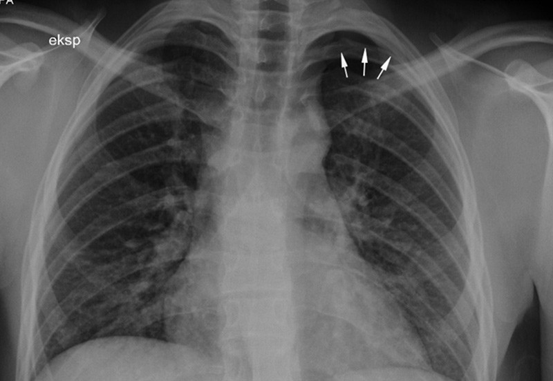 Figur 1  R&oslash;ntgen thorax tatt under ekspirasjon viser en 12 mm apikal luftkappe p&aring; venstre side