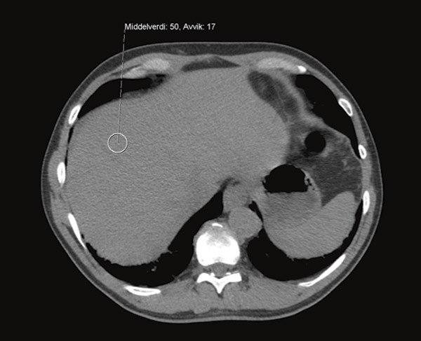 Figur 2  CT abdomen uten kontrast fra pasient uten patologiske forandringer
