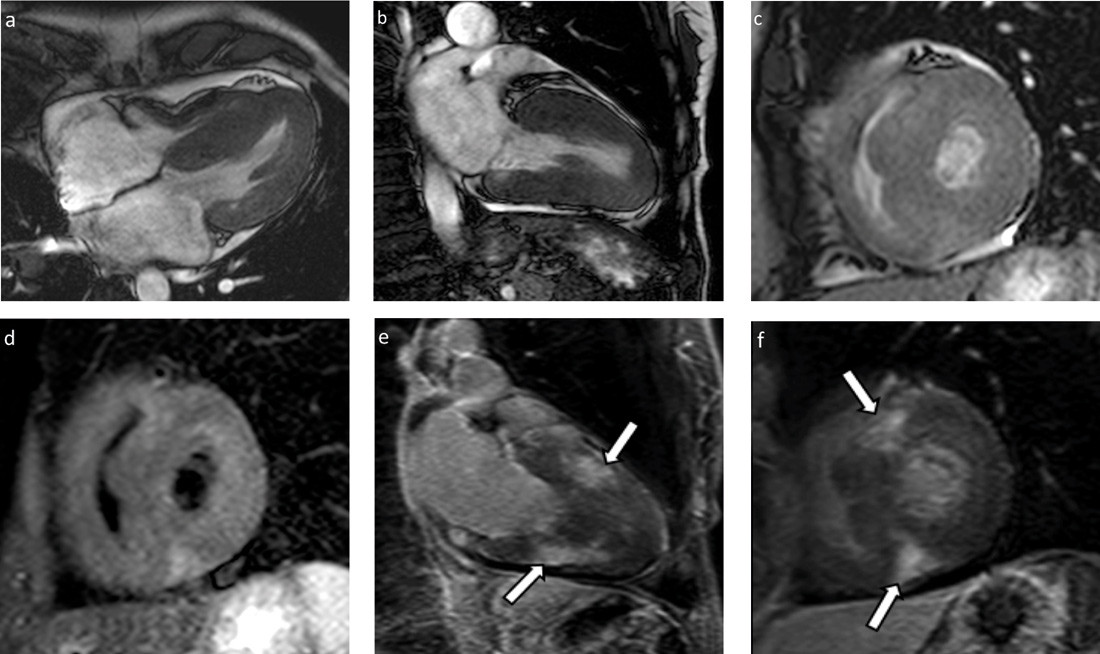 Figur 3  MR-unders&oslash;kelse. Funksjonsseriene viser fortykket myokard i begge ventrikler &ndash; a) firekammer, b) langakse, c)&hellip;
