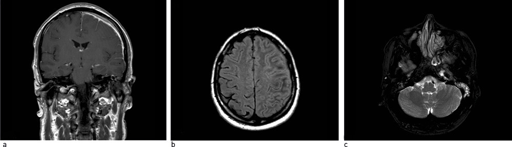 Figur 1  MR caput. a) T1-sekvens med kontrast. Hevelse i meningene over venstre hemisf&aelig;re med kontrastopptak. b) T2-sekvens&hellip;