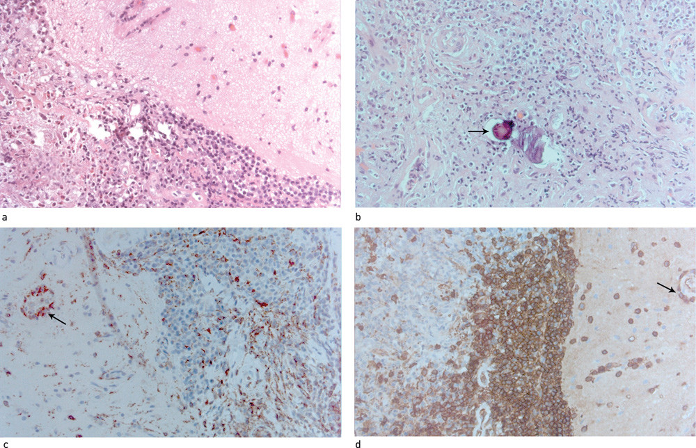 Figur 2  Biopsi av dura frontalt p&aring; venstre side. Histopatologisk unders&oslash;kelse viser fortykket dura med fibrose og&hellip;