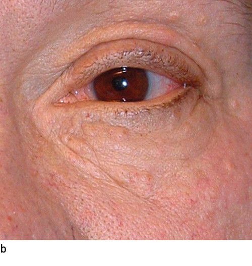 Figur 1  I huda var det talrike sm&aring; knutar b&aring;de p&aring; kroppen og i ansiktet. I conjunctiva ser ein karinjeksjon og einskilde&hellip;