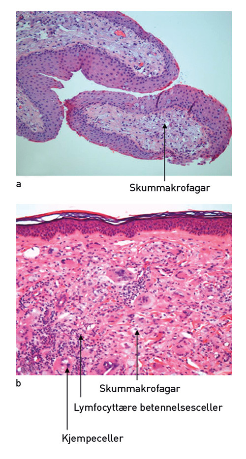 Figur 2  a) Biopsi fr&aring; conjunctiva viste avleiring av lipid i makrofagar. b) Hudbiopsi viste veldifferensiert epidermis,&hellip;