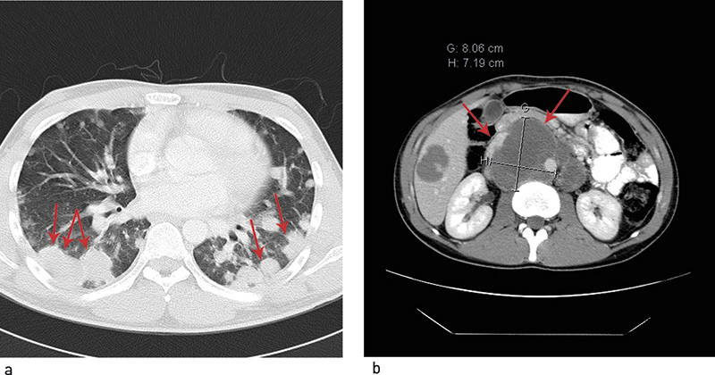 Figur 1  CT-bilder f&oslash;r oppstart av behandling. a) Betydelige rundfortetninger i begge lunger forenlig med utbredt&hellip;
