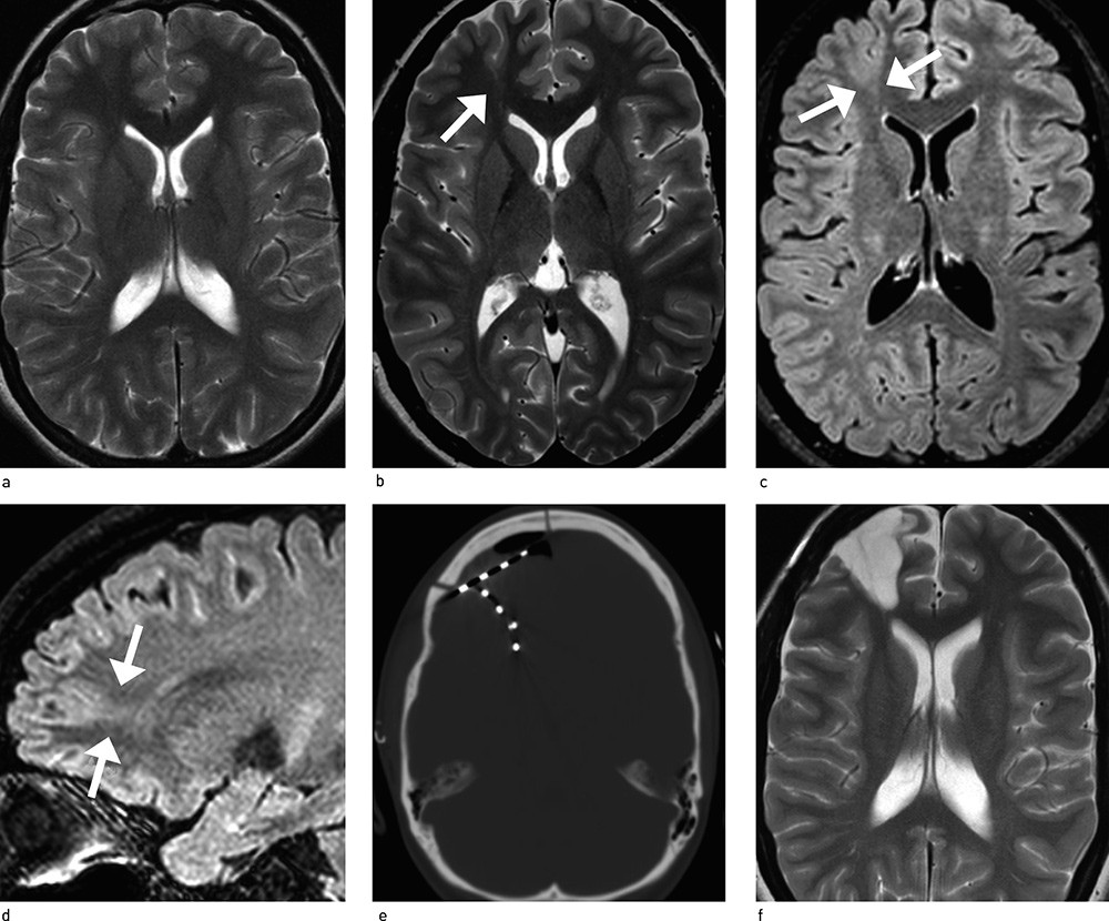 Figur 1  Pasient med terapiresistent epilepsi som har v&aelig;rt unders&oslash;kt etter &laquo;epilepsiprotokoll&raquo; med en 1,5 tesla MR-maskin &ndash;&hellip;