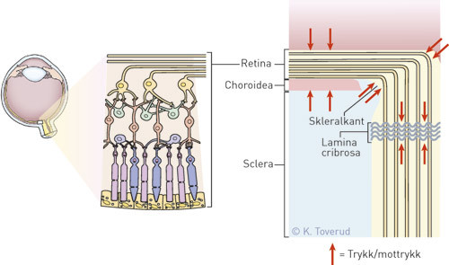 Retinafibrene blir presset sammen under systolen, samtidig som lamina cribrosa med nervefibre blir forskj&oslash;vet bakover. Denne&hellip;
