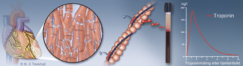 Troponinm&aring;ling etter hjerteinfarkt