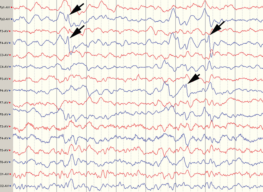 Figur 1  EEG to uker etter innleggelse viser langsom aktivitet, mest uttalt i h&oslash;yre hemisf&aelig;re (bl&aring; kurve) og enkeltst&aring;ende&hellip;